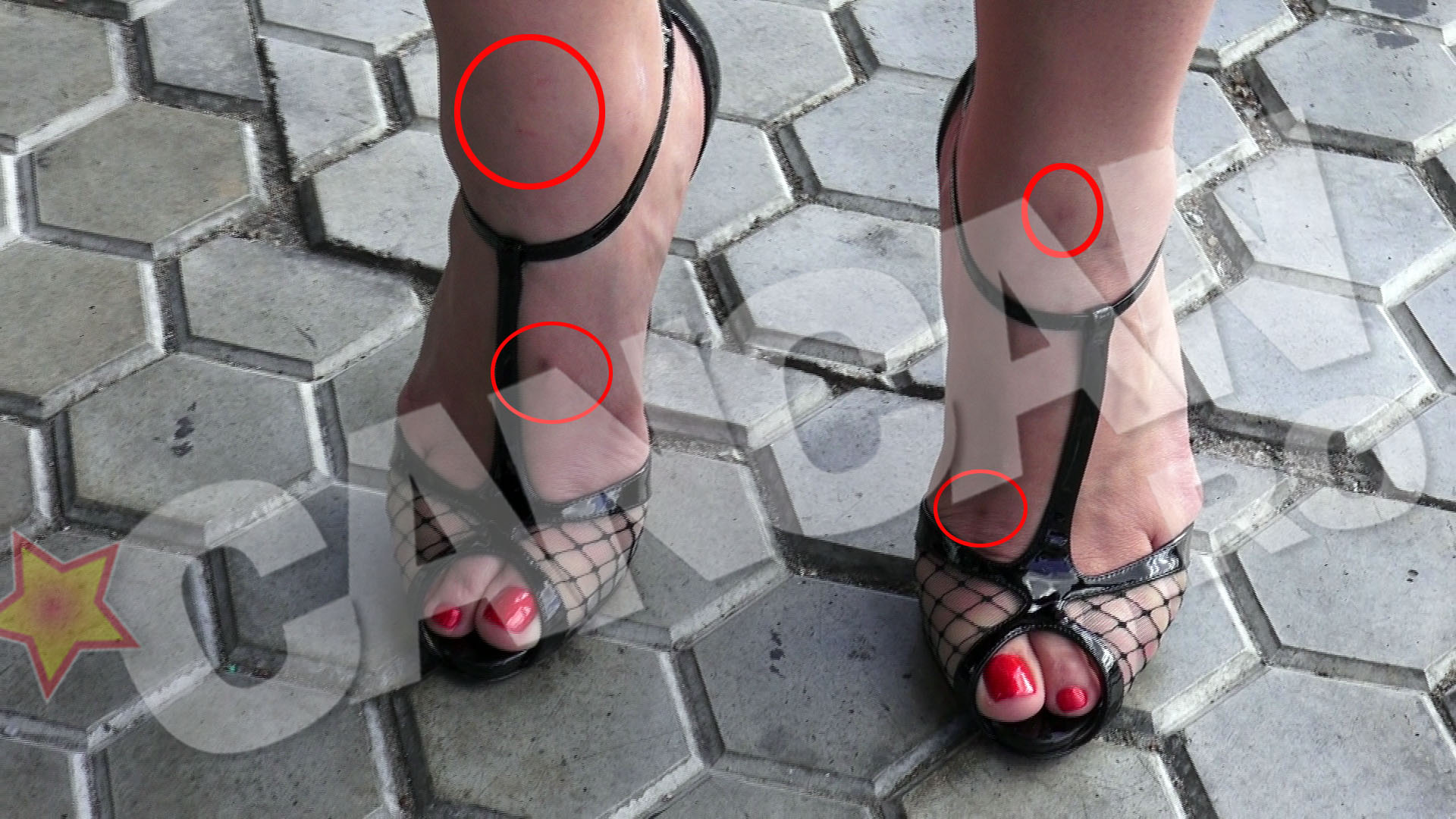 Vanataile de pe picioare par urmele unei liposuctii realizate de curand