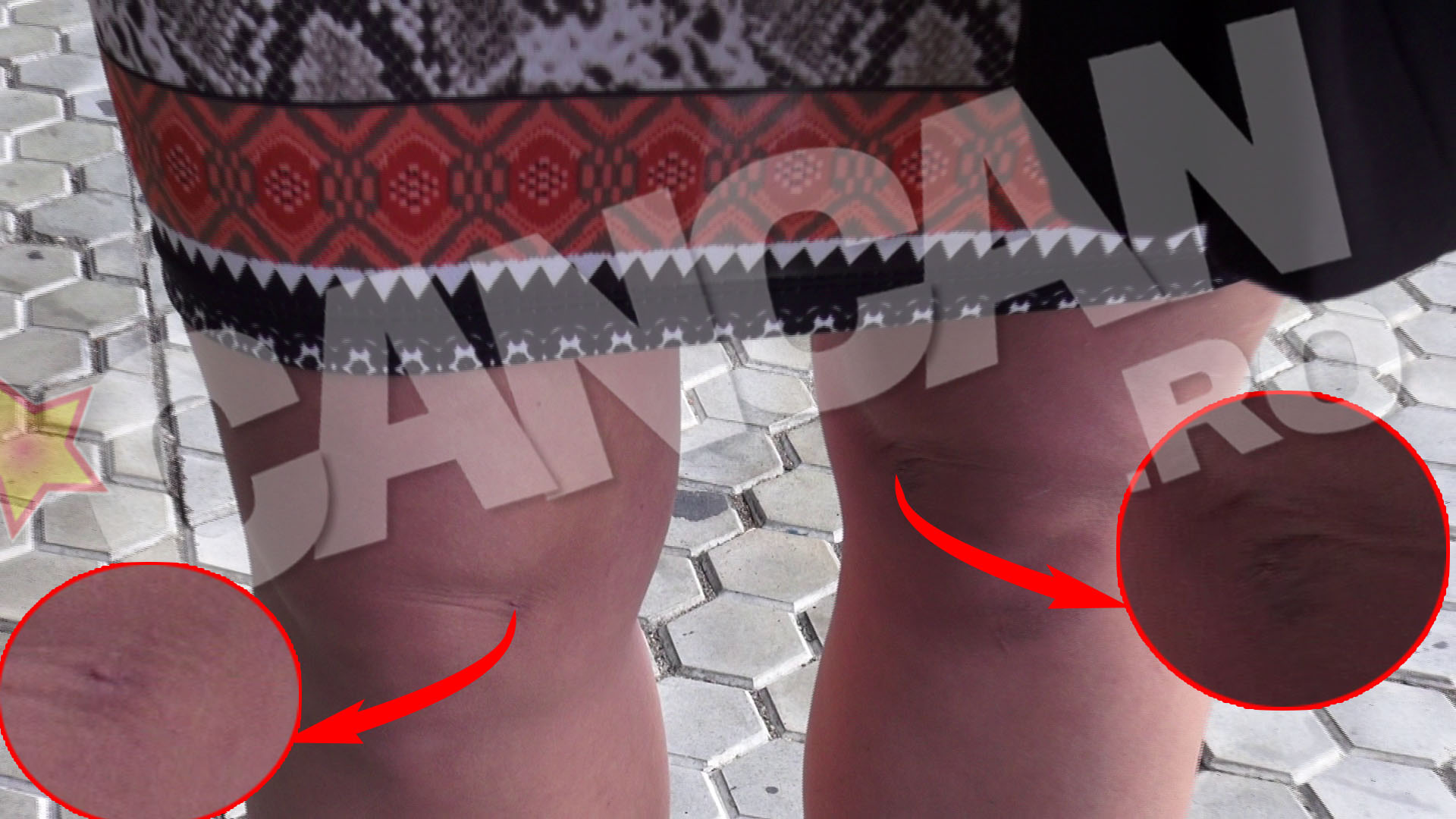 Genunchii Alexandrei Harra nu sunt in cea mai buna forma si au urme de liposuctie