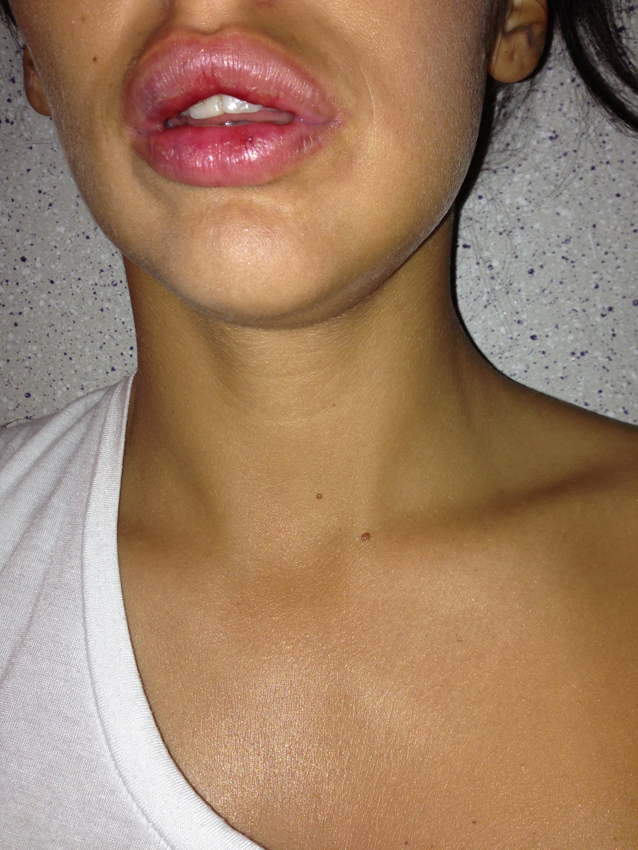 Vineri noaptea, Bianca a fost agresata in club de fostul ei iubit, care i-a spart buza in timp ce i-a muscat-o