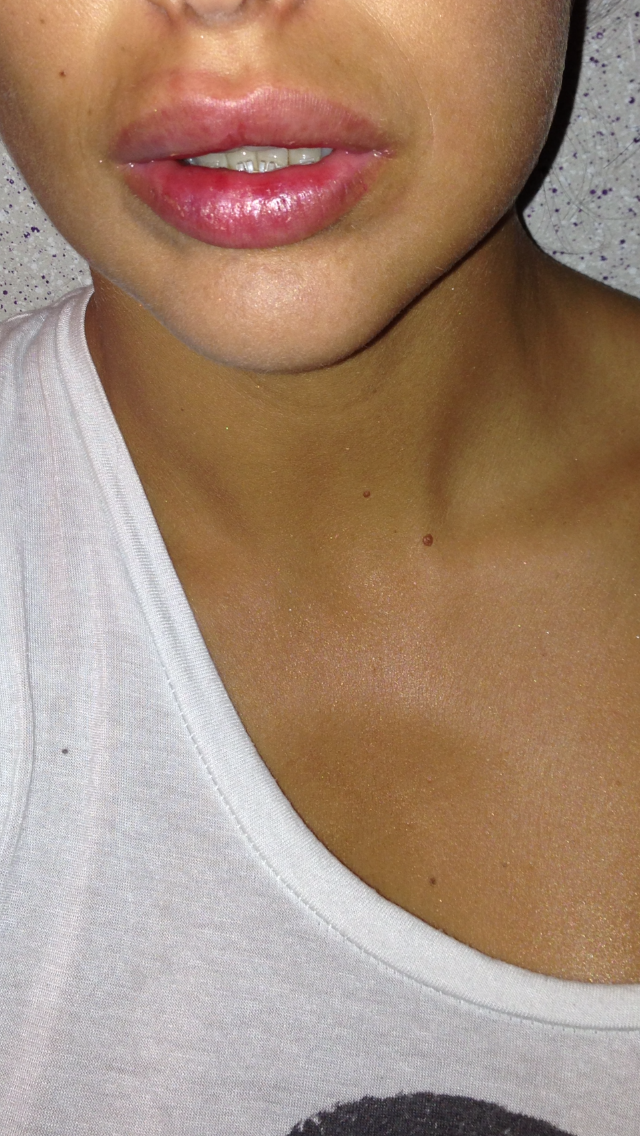 Bianca s-a ales cu o umflatura si cu o buba inestetica, la buza, dupa ce fostul ei iubit a muscat-o