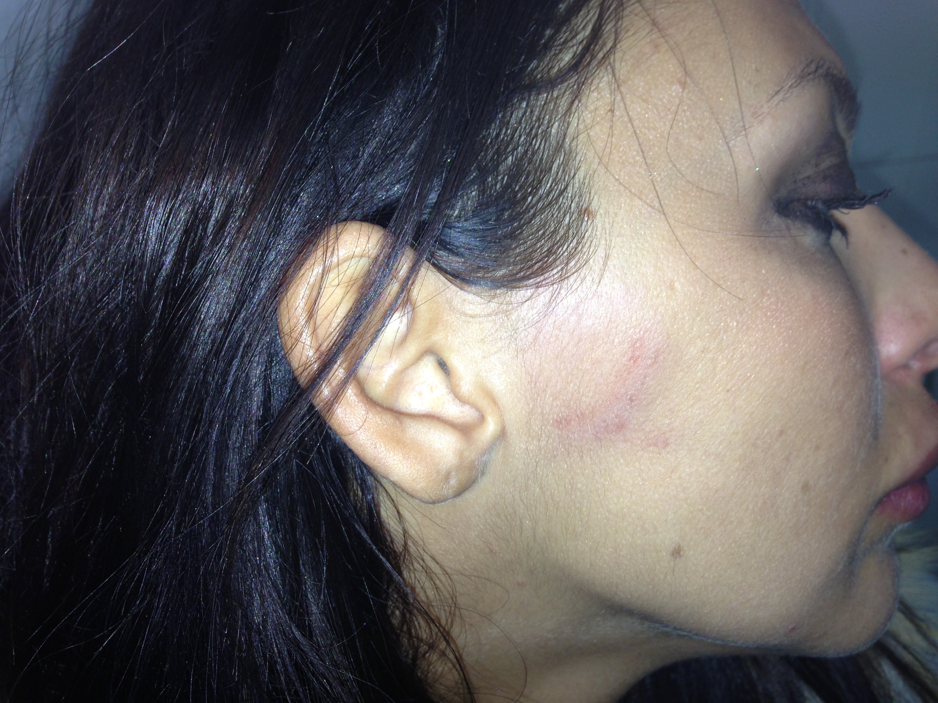 Bianca Jurca are si o vanataie pe fata, care provine tot de la o muscatura, dupa cum ea sustine