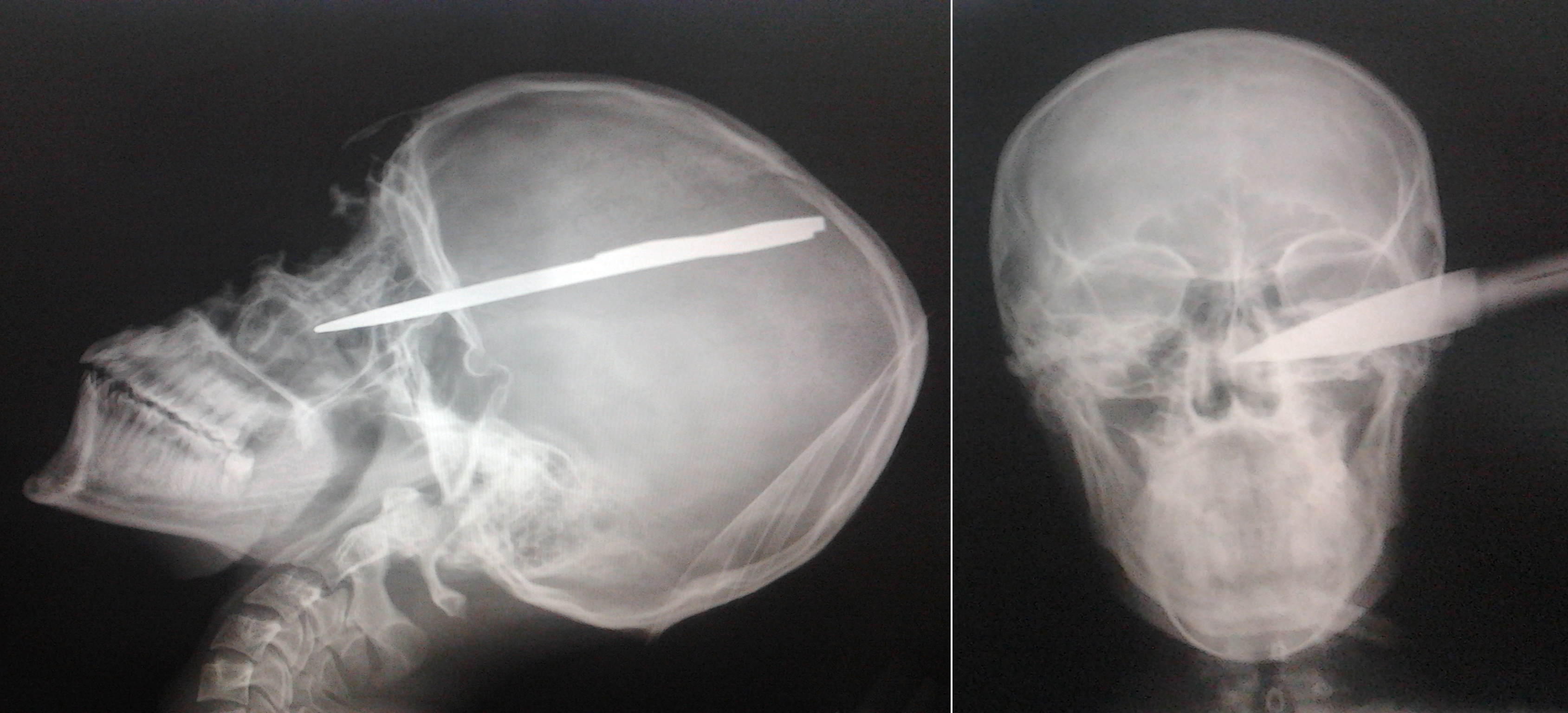 Sabia cu care a fost lovit tanarul nu a afectat niciun element vascular