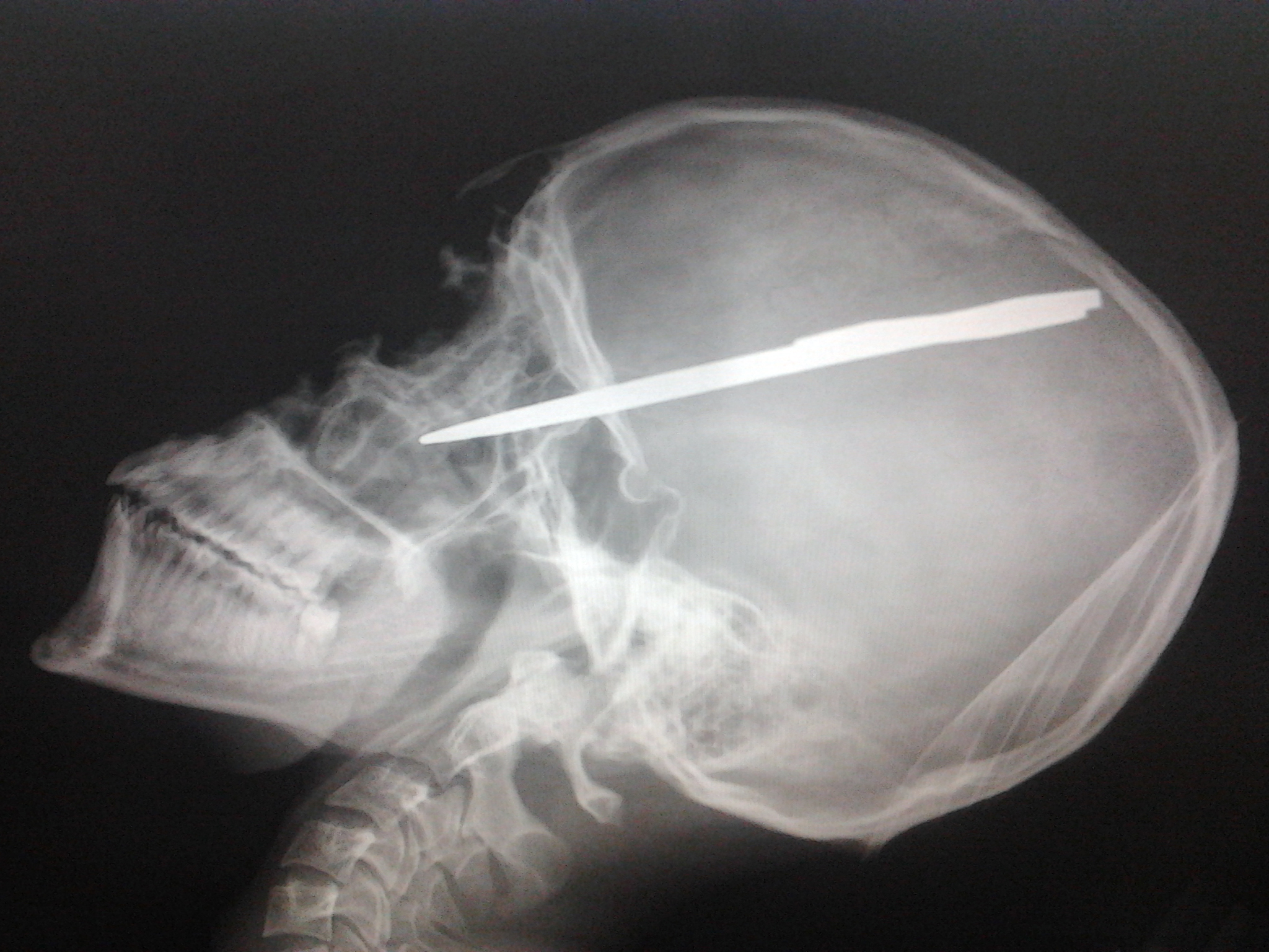 Sabia a intrat circa sase centimetri