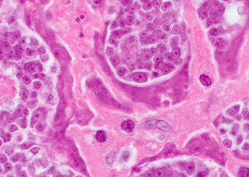În această fotografie: celule tumorale maligne apărute în urma infecţiei cu viermi paraziţi.