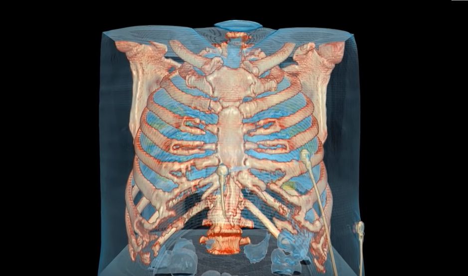 Imagine Stire Imagini înspăimântătoare. Cum distruge noul coronavirus un plămân. VIDEO 3D | 2review.ro