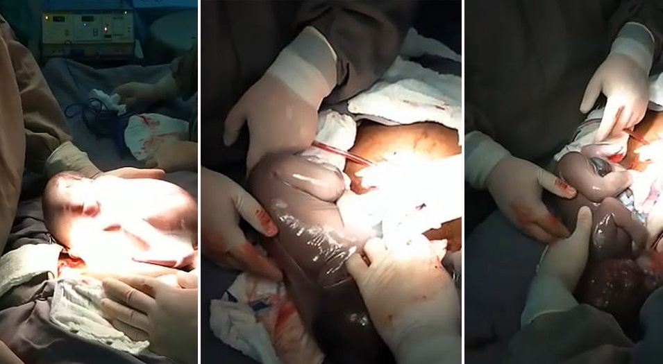 Imagini emoționante în sala de operații: un băiețel s-a născut în timp ce era încă în sacul amniotic. Cazul este foarte rar: 1 la 80.000 de nașteri | FOTO & VIDEO