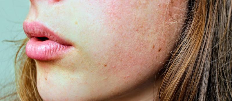 Persoanele cu un ten sensibil, probleme din cauza măștii de protecție! Ce este dermatita alergică de contact și cum scapi de ea. Sfatul medicilor
