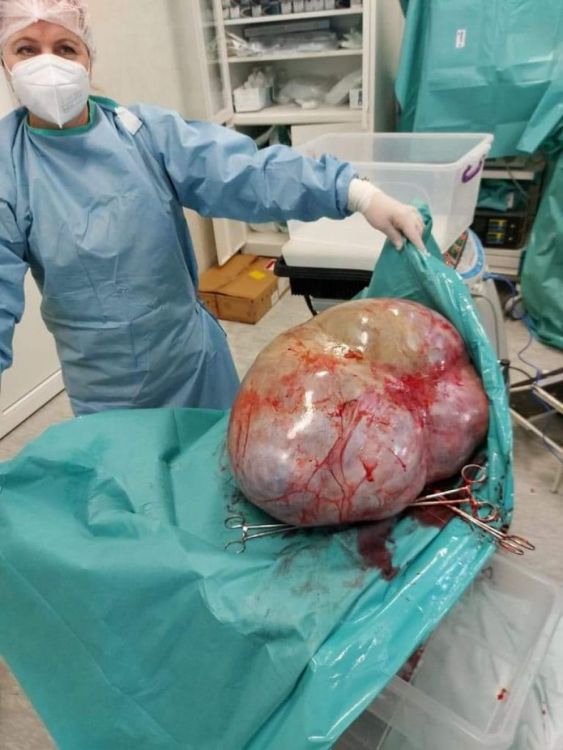 Imagine Stire FOTO. Caz incredibil la Botoșani. Tumoare de 24 de kilograme, extirpată din abdomenul unei femei infectată cu COVID-19 | 2review.ro