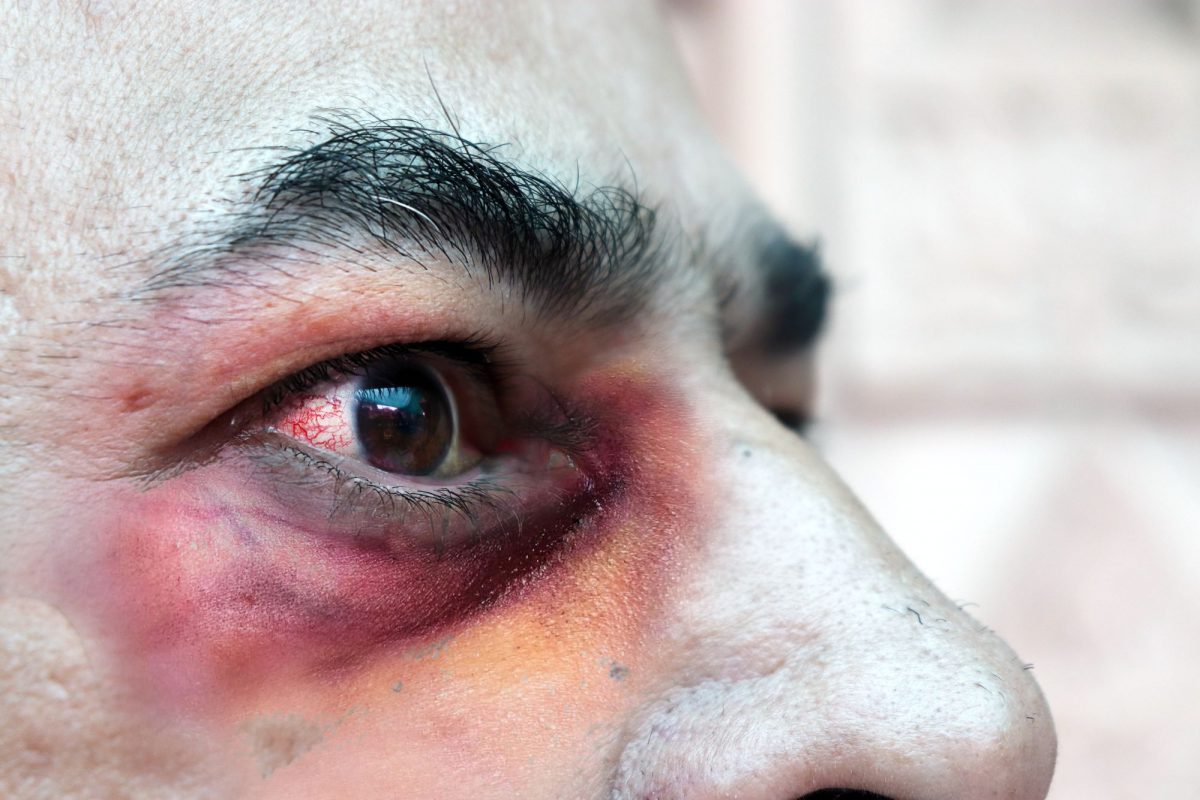 Imagine Stire Alertă! „Ciuperca neagră”, care lasă bolnavii de COVID-19 fără ochi, a început să se răspândească în lume | 2review.ro