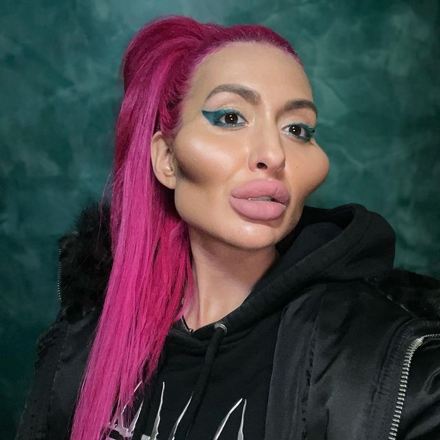 Imagine Stire Cum a ajuns să arate o femeie dependentă de botox! Doctorii i-au spus să se oprească | 2review.ro