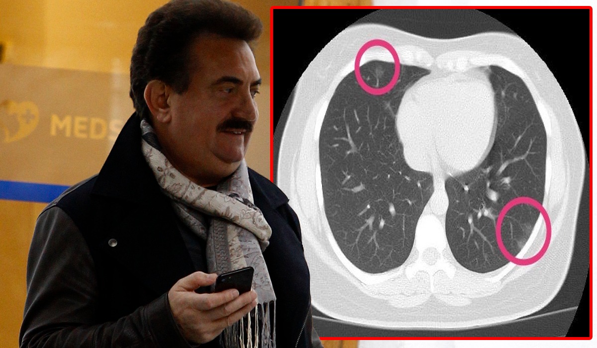 Adevărul despre moartea lui Petrică Mâțu Stoian. Ce au descoperit medicii pe unul dintre plămânii artistului