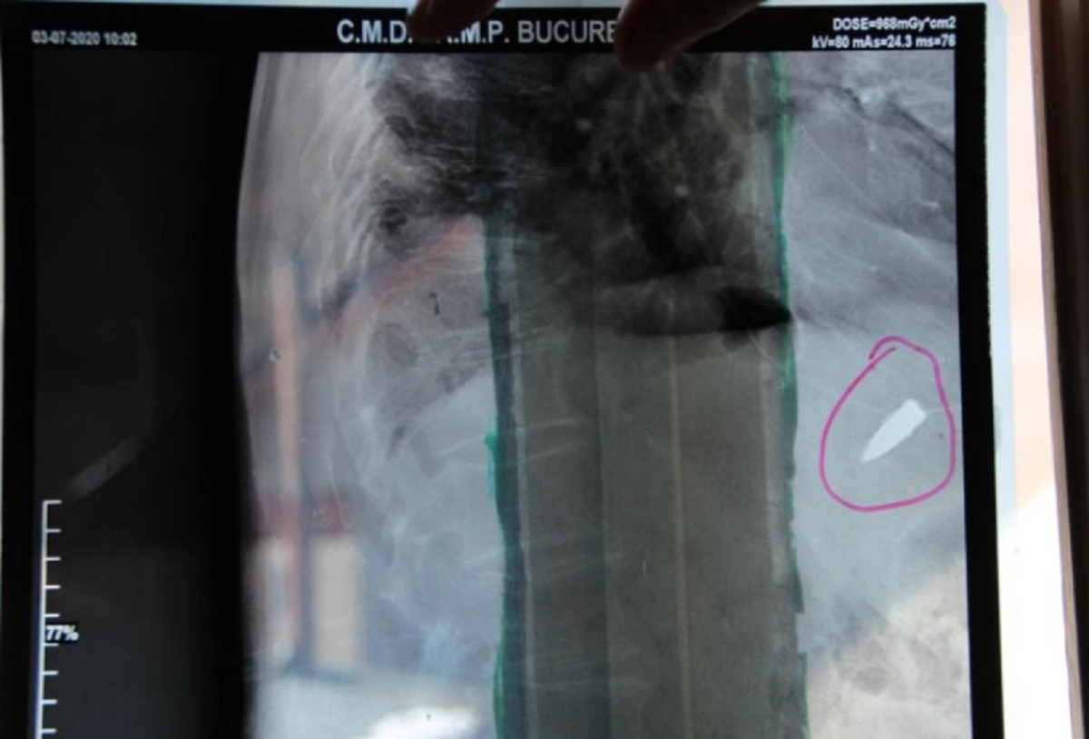 Imagine Stire El este românul care trăiește de 80 de ani cu un glonț lângă inimă. Povestea care a făcut înconjurul lumii | 2review.ro