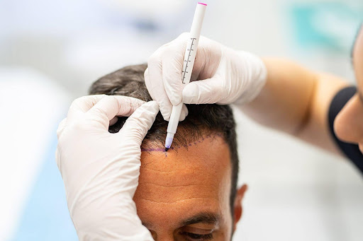10 motive să îți faci un implant de păr – recâștigă-ți aspectul întinerit!