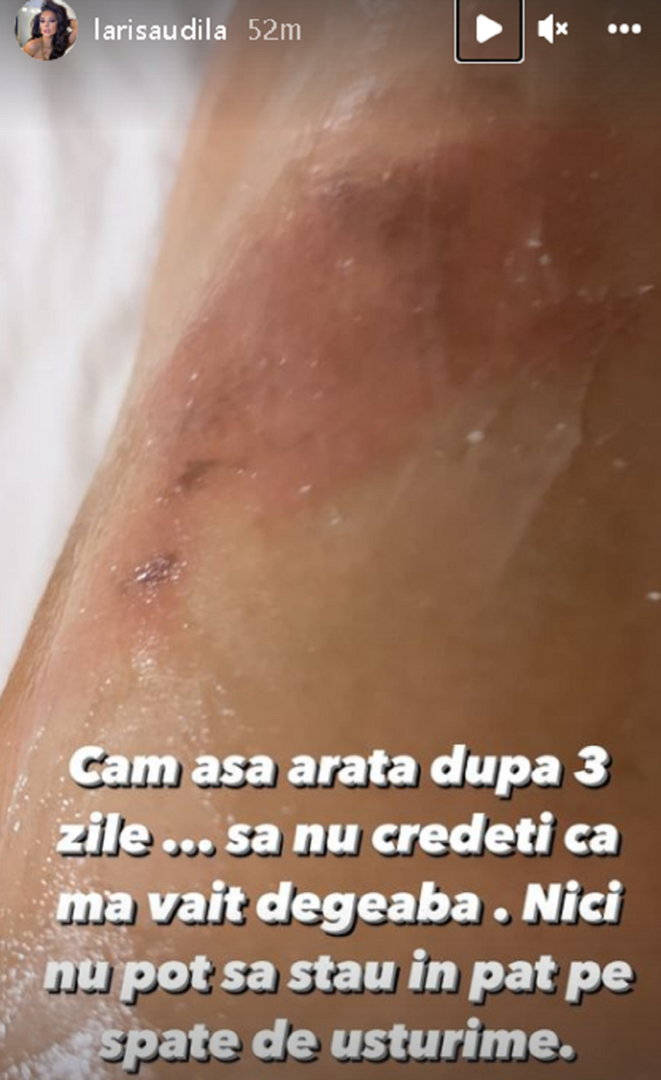 Imagine Stire Larisa Udilă, arsă pe picior din cauza soțului. Vedeta îndură dureri cumplite: ”Am început să plâng isteric până am rămas fără voce” | 2review.ro