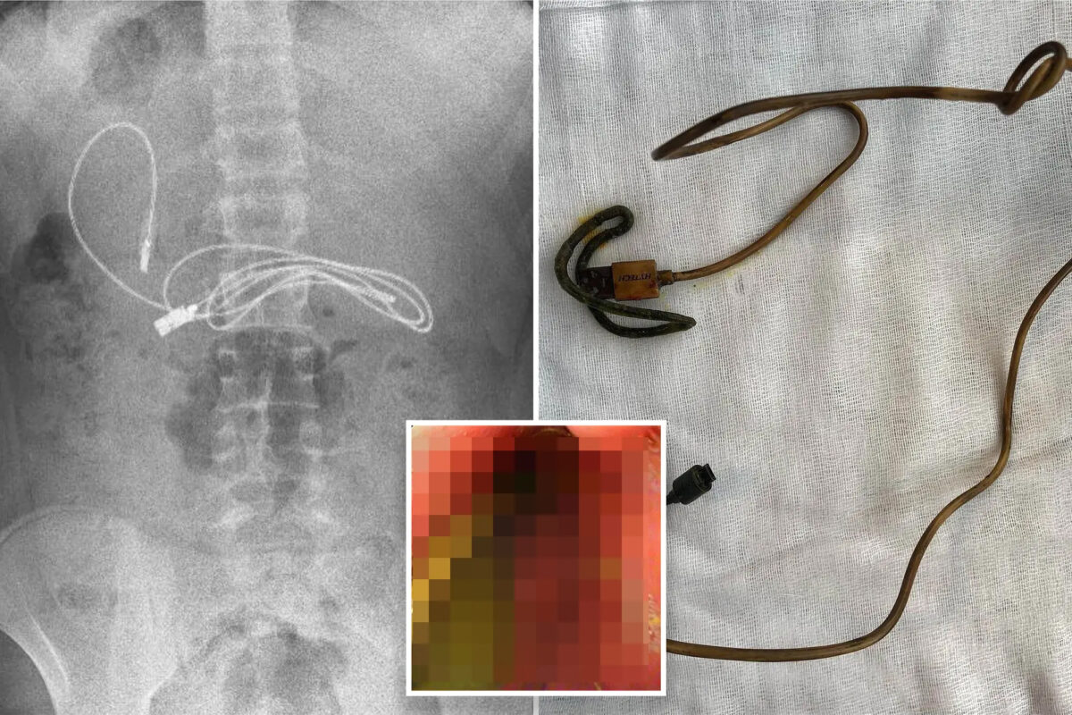 Medicii au crezut că nu văd bine! Ce gadget au putut găsi în stomacul unui adolescent care acuza dureri de burtă
