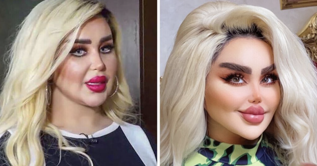 Imagine Stire Dalia a vrut să arate ca păpușa Barbie, dar rezultatul i-a șocat pe apropiați. După 43 de operații, tânăra de 30 de ani este asemănată cu un zombi | 2review.ro