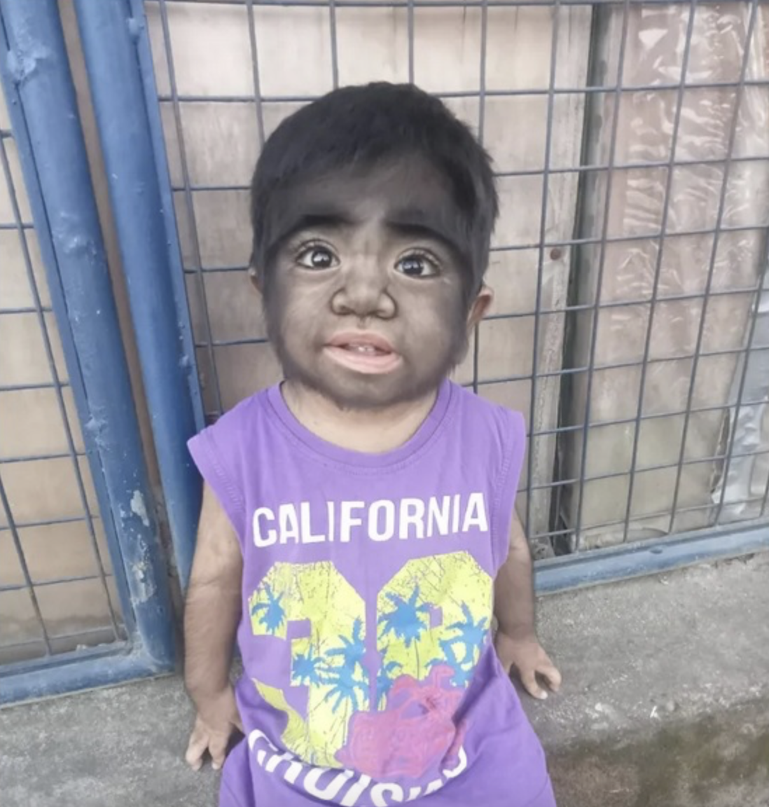 Bebelușul care s-a născut cu sindromul vărcolacului