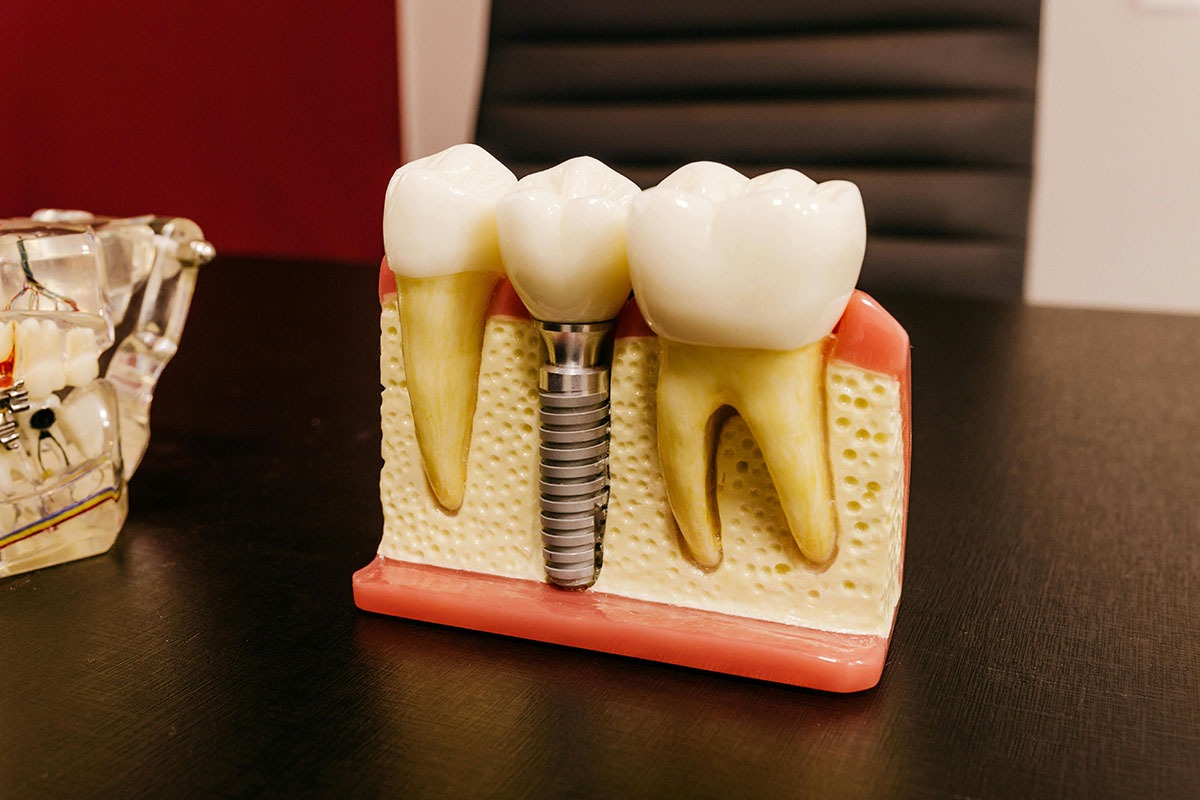 (P) Implanturi dentare rapide – transformare wow în doar 24 de ore!
