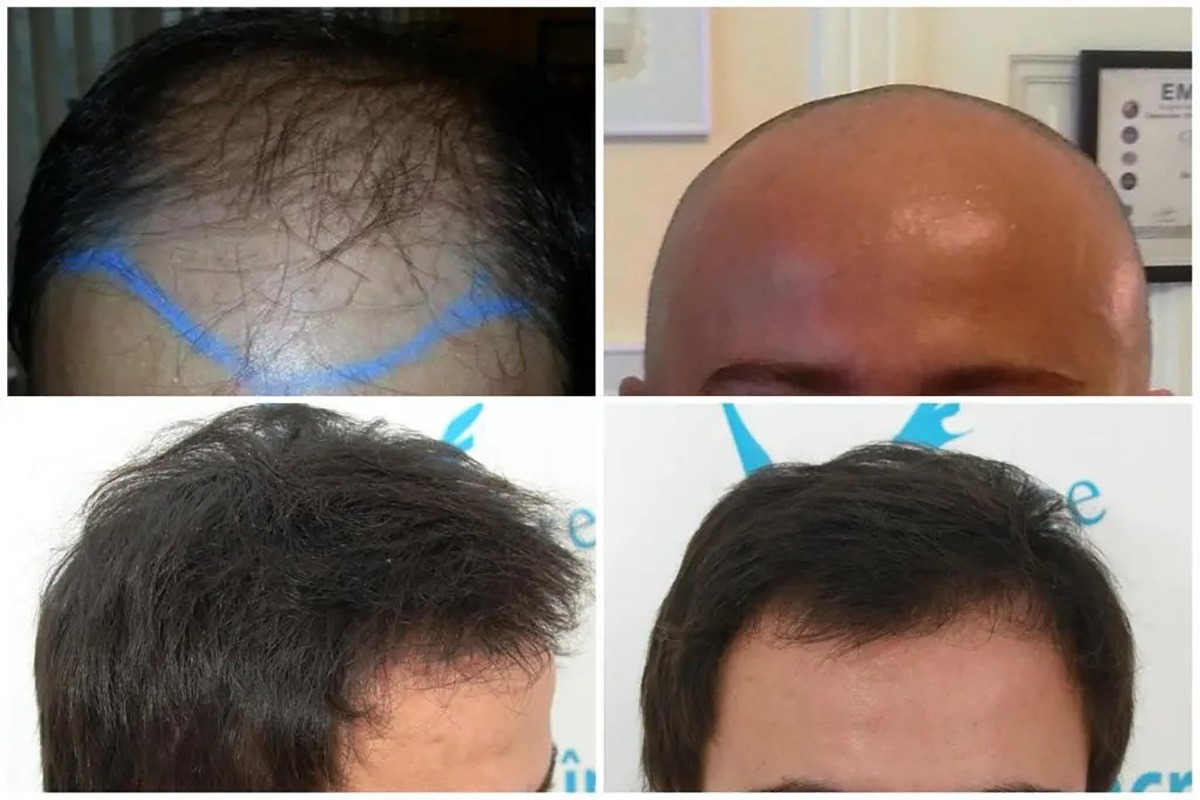 (P) Știai că implant de par Q-FUE manual avansat te ajută să arăți mai tânăr? Iată ce implică
