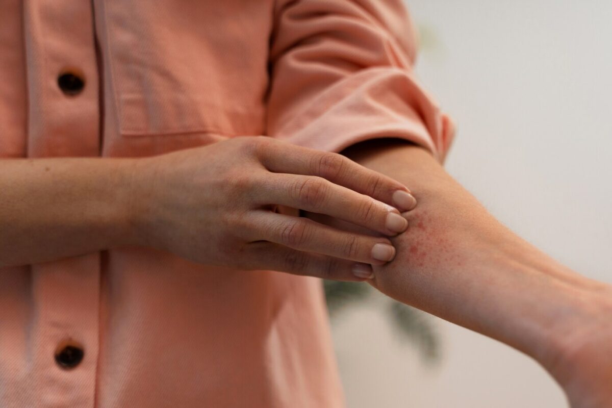 (P) Tratament pentru psoriazis ușor de urmat și integrat în rutina zilnică. Remisie îndelungată și efecte vizibile rapid