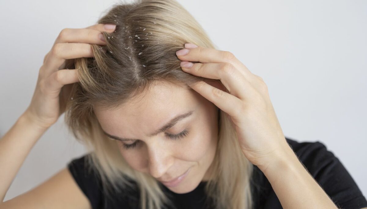 Când scalpul cere ajutor: dermatita seboreică și soluțiile naturale care pot calma pielea