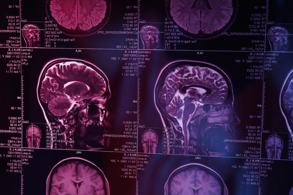 Gestul aparent inofensiv care îți poate dubla riscul de AVC