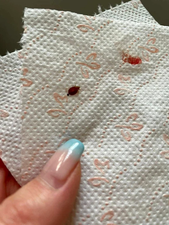 Imagine postată de soția bărbatului afectat de ploșnițe