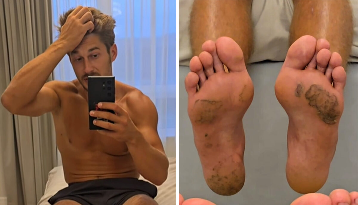 Imagine Stire Cum arată tălpile concurenților de la Survivor, după ce au stat desculți 4 luni în jungla dominicană. Întors în România, Alberto Hangan a făcut publice imaginile | 2review.ro