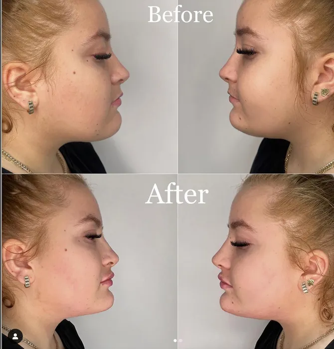 tatiana final boss si-a marit buzele cu acid hialuronic (2)